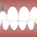 Prosthodontist implant