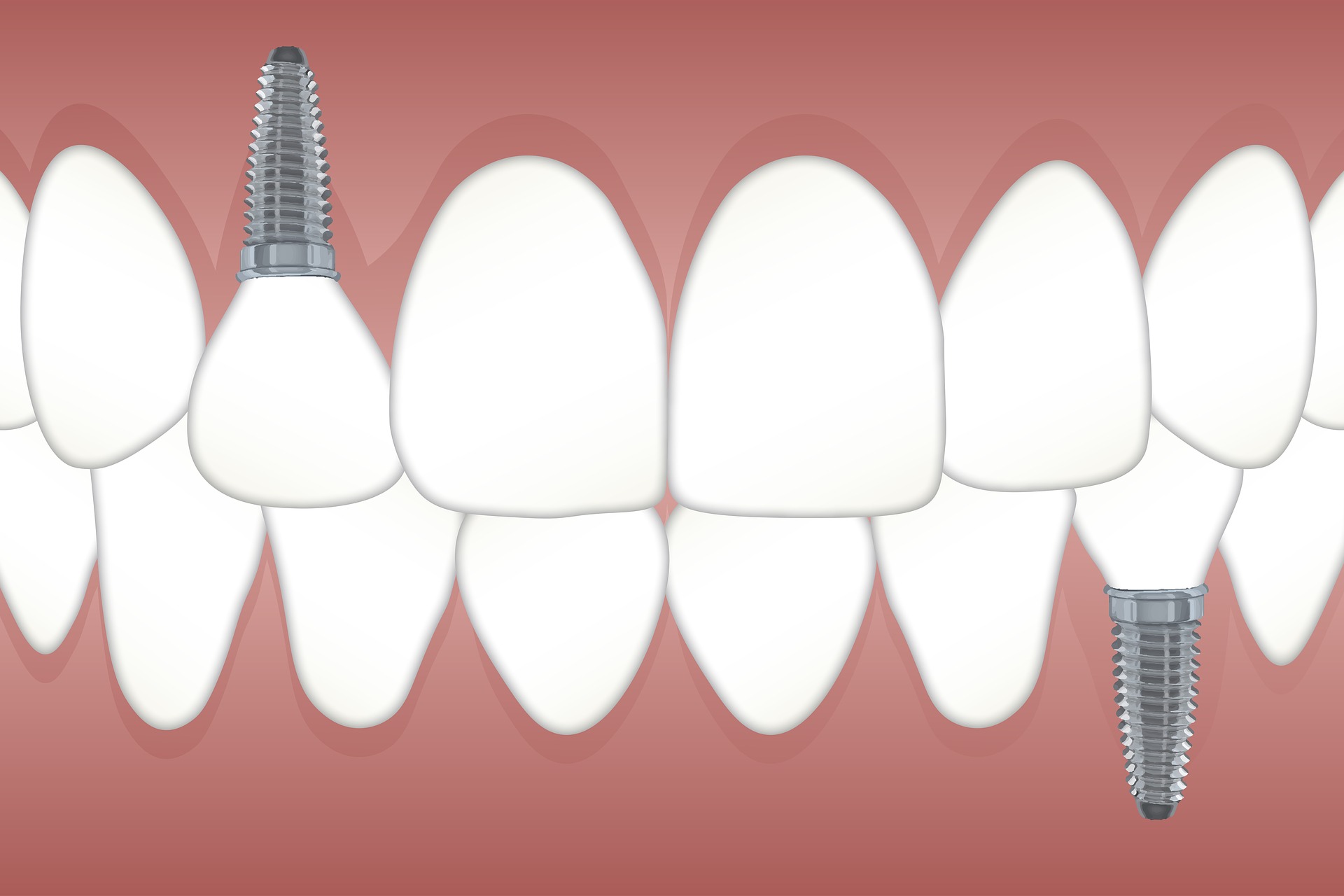 Prosthodontist implant